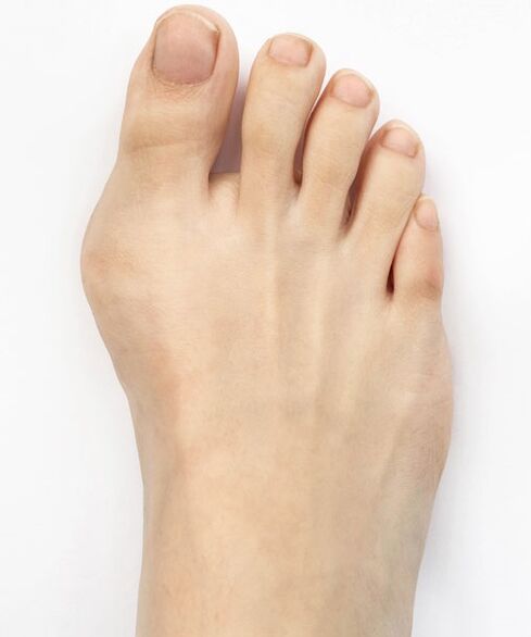alluce valgo prima di usare lo spray Hondro Sol Valgus