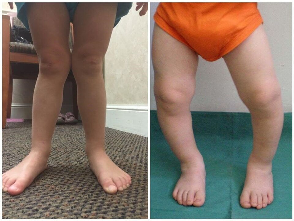 La deformazione di Valgus nei bambini cause
