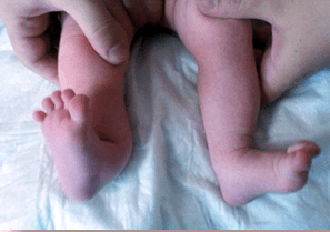 Valgus Deformation nei sintomi dei bambini