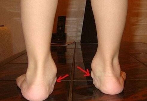Valgus Deformazione dei piedi nei bambini