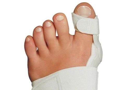 Deformazione valgus