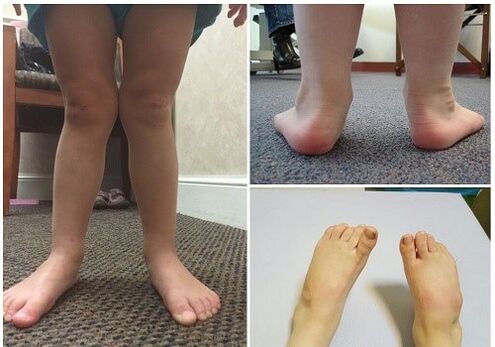 Valgus Deformation nei bambini